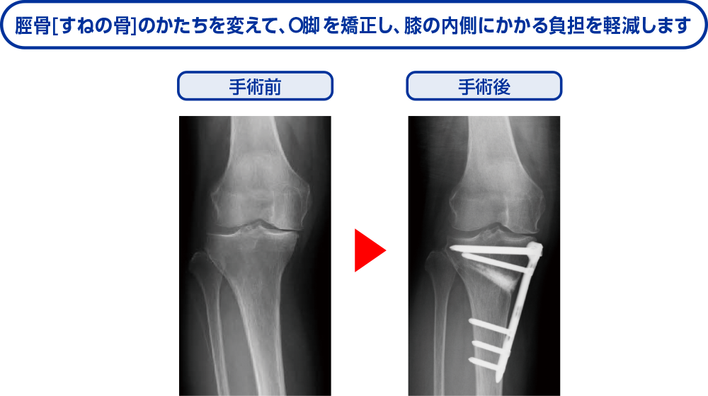 脛骨［すねの骨］のかたちを変えて、Ｏ脚を矯正し、膝の内側にかかる負担を軽減します